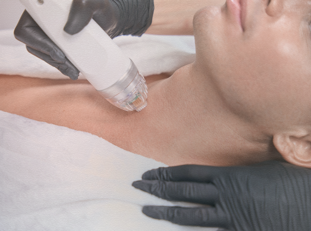 Morpheus8 aesthetic treatment